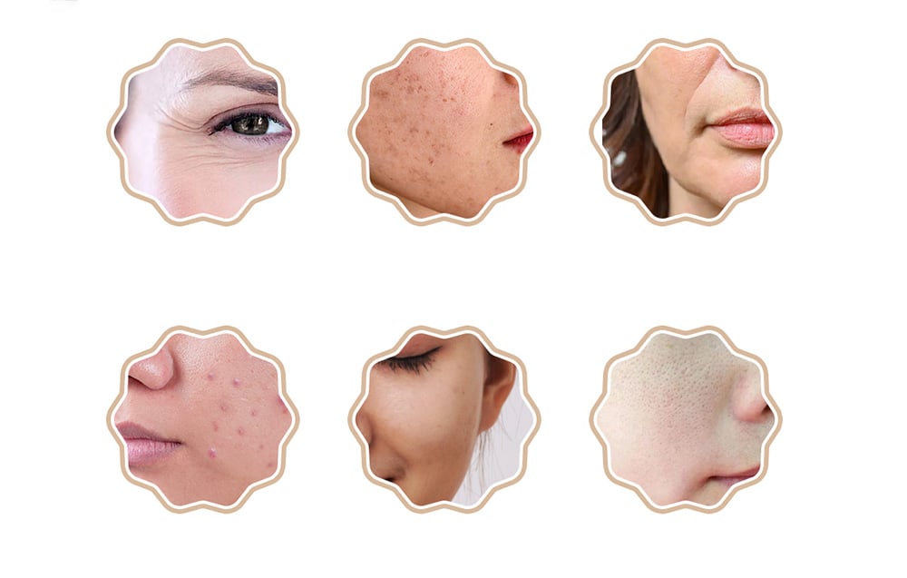 Sześć okrągłych zdjęć pokazujących różne problemy skórne i ich poprawę